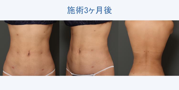 腹部全周+腰+背中の脂肪吸引+ボディタイト 施術3ヶ月後の症例写真