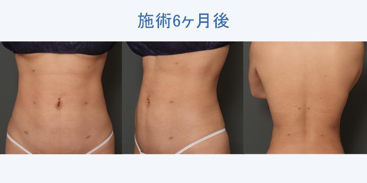 腹部全周+腰+背中の脂肪吸引+ボディタイト 施術6ヶ月後の症例写真