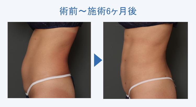 腹部全周+腰+背中の脂肪吸引+ボディタイト 術前術後の比較3