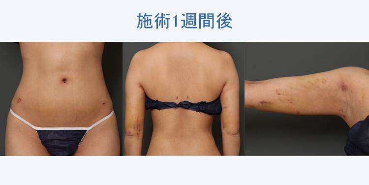 二の腕+ウエスト+腰+腹部+背中上下の脂肪吸引 施術1週間後の症例写真