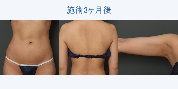 二の腕+ウエスト+腰+腹部+背中上下の脂肪吸引 施術3ヶ月後の症例写真