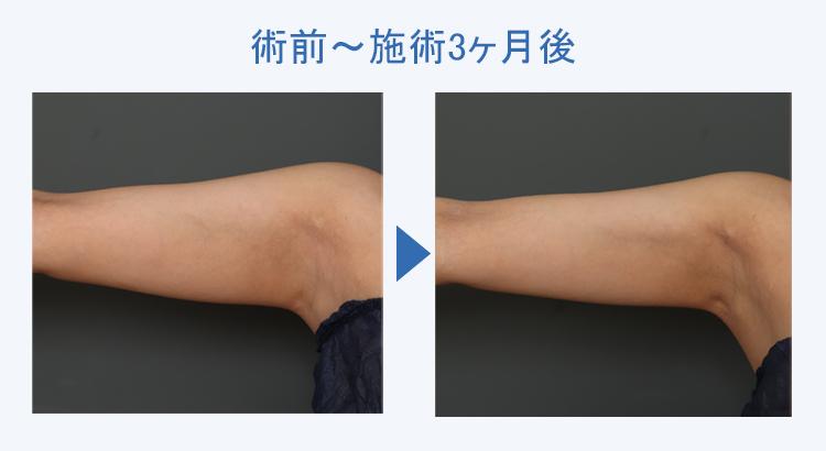 二の腕+ウエスト+腰+腹部+背中上下の脂肪吸引 術前術後の比較3