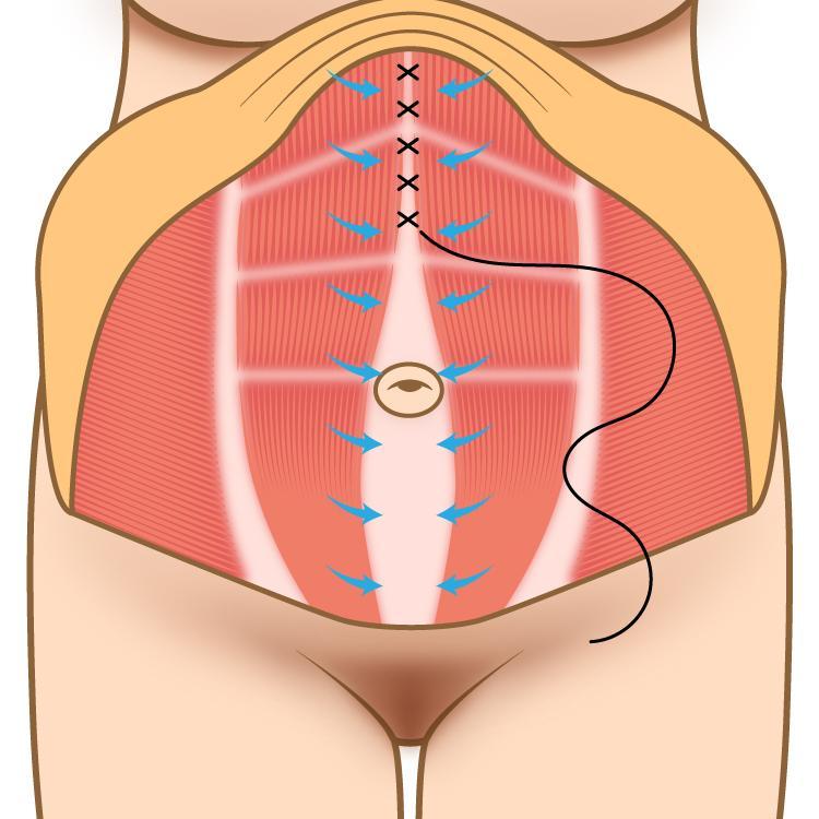 腹直筋離開はどんな状態か?