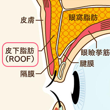 平行二重にならない原因2：まぶたの脂肪やまぶたの皮膚が厚い