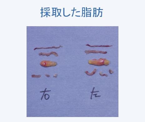 実際に採取した脂肪、処理した挙筋腱膜等