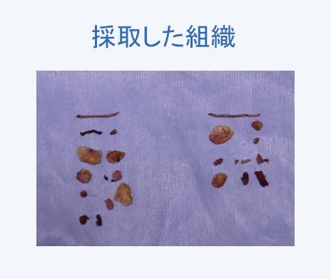 実際に採取した挙筋腱膜や眼窩脂肪