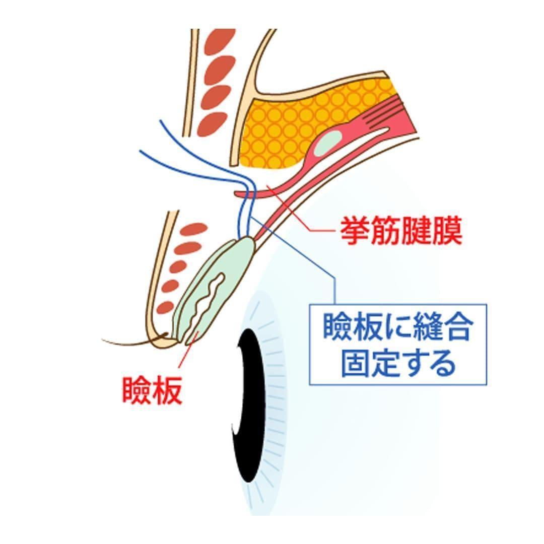 挙筋腱膜を引き出して瞼板に縫合固定