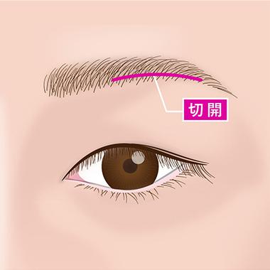 7.しっかり改善したい：眉下切開法