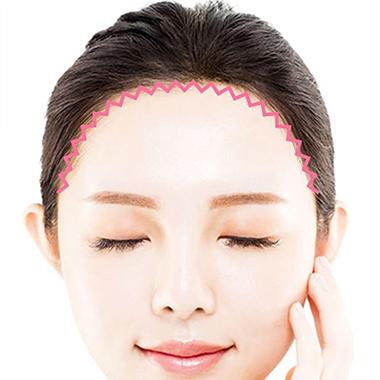 9.眉・額の下がりが原因なら：前額リフト