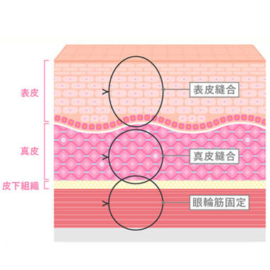 3層縫合について