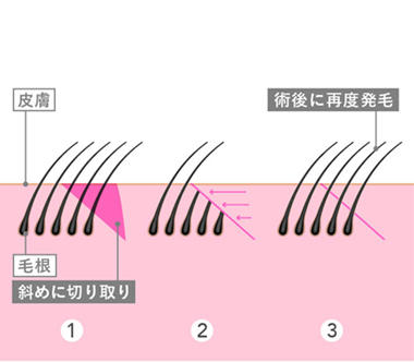 オザキクリニックがおこなっている眉下切開の手法「毛包斜切断法」について