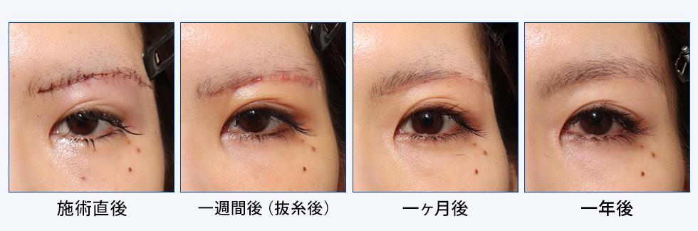 眉下切開法 アイリフト の傷跡やダウンタイムは おすすめの手法も紹介 公式 オザキクリニック