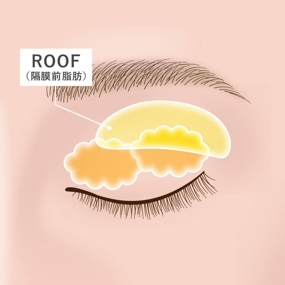 まぶたの脂肪 - ROOF