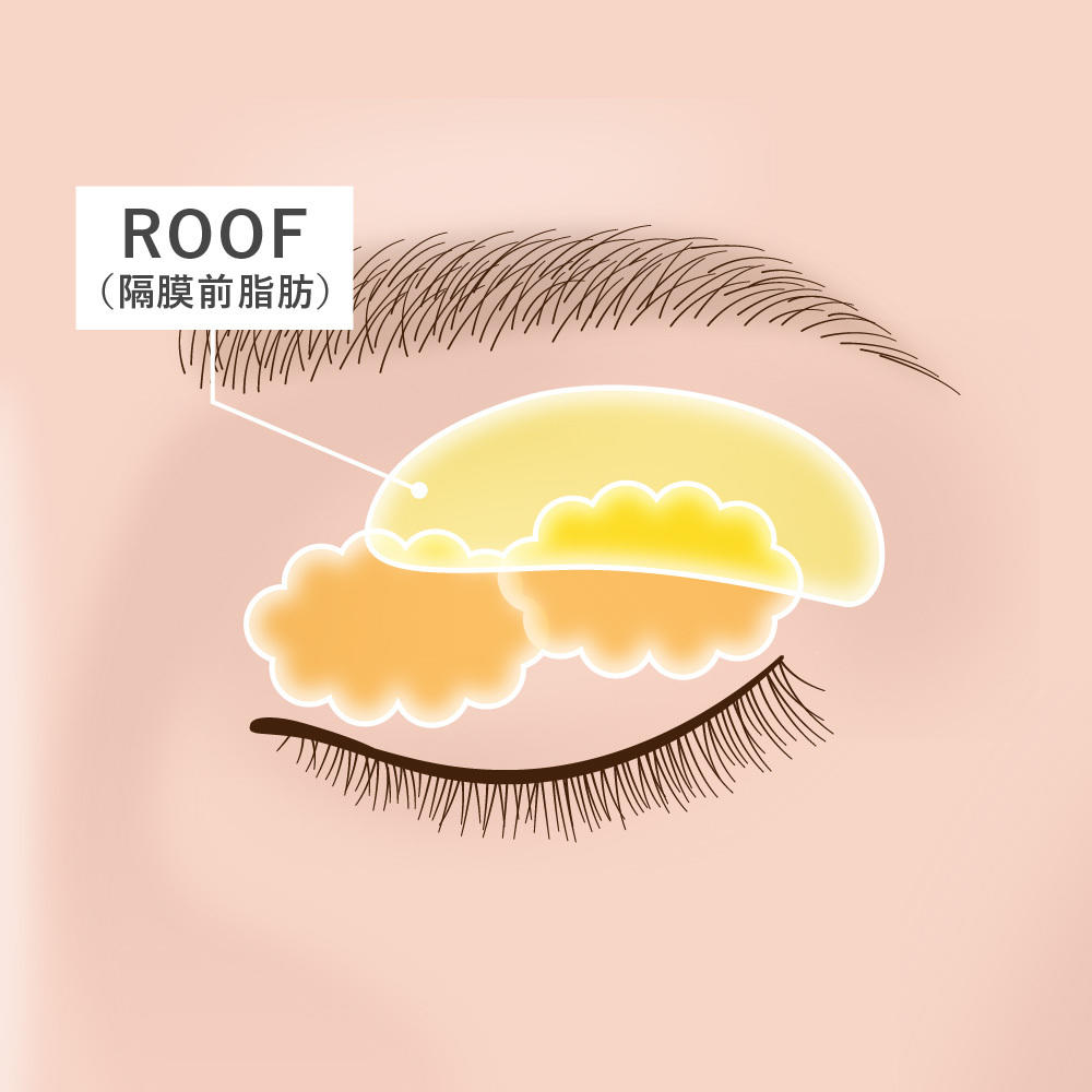 まぶたの脂肪が多いと 腫れぼったい目の原因に 眉下切開法で悩みを解消 公式 オザキクリニック