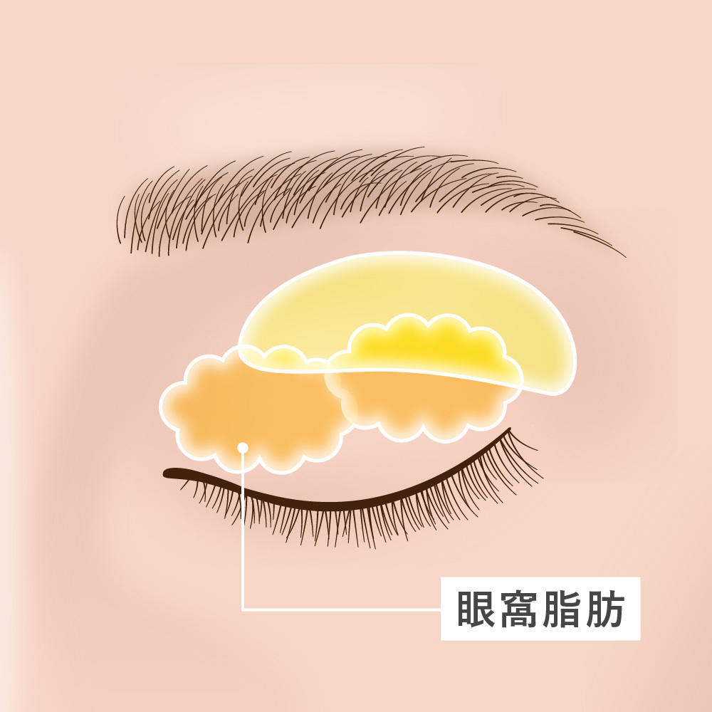 まぶたの脂肪 - 眼窩脂肪