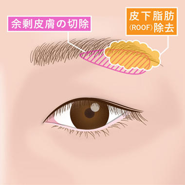 オザキクリニックでおこなう眉下切開法について