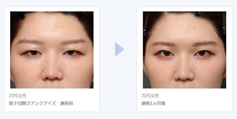 眉下切開法でまぶたの脂肪を除去した症例写真 - 1