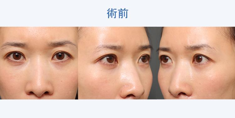眉下切開法 術前写真