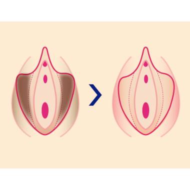 黒ずみを改善する小陰唇縮小術