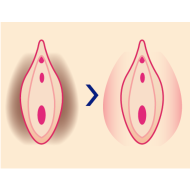 黒ずみを改善する大陰唇縮小術