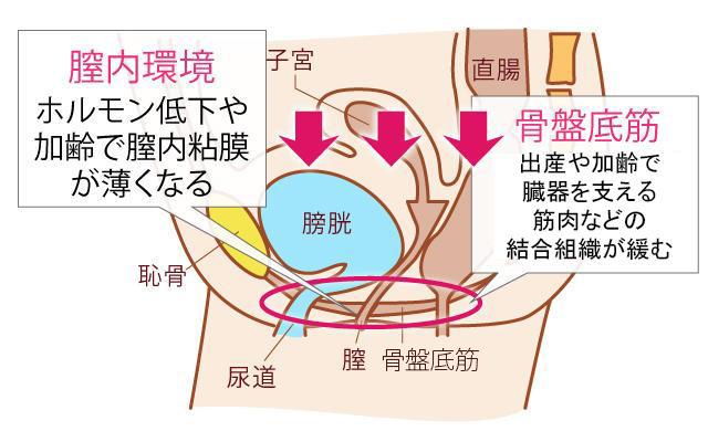 尿もれが起こる原因