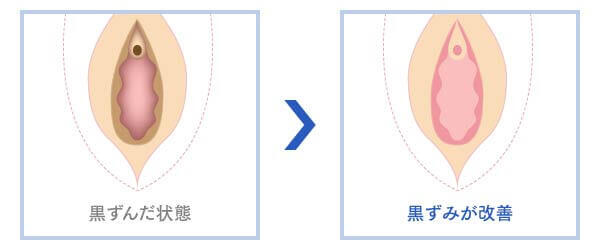 インティマレーザーによる黒ずみ除去のやり方