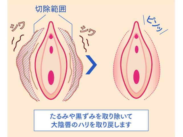 たるみを改善する施術！大陰唇縮小術