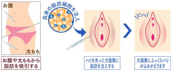 自己細胞でふっくら！大陰唇増大術（脂肪注入）