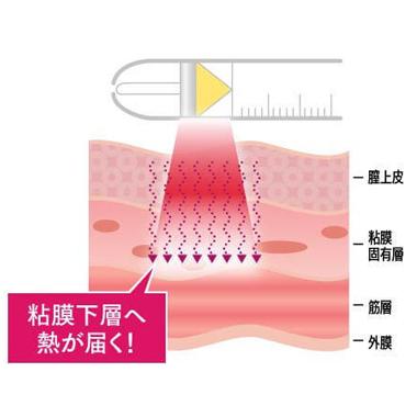 インティマレーザーは何がすごい？