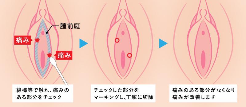 膣前庭部切除術とは？