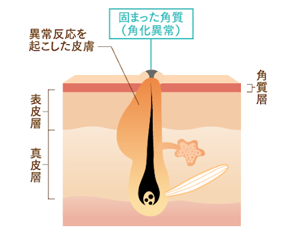 毛孔性苔癬の原因