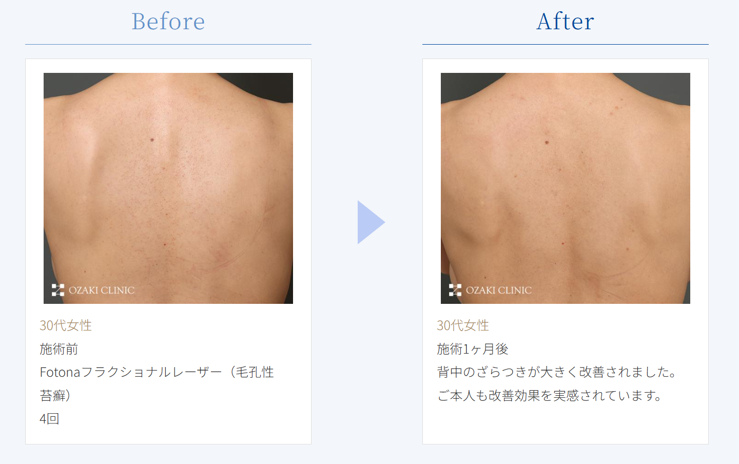 Fotonaフラクショナルレーザー（毛孔性苔癬）の症例写真