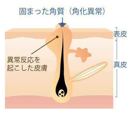毛孔性苔癬（もうこうせいたいせん）とは？原因や特徴を解説