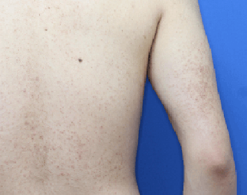 column_lichen-pilaris06_contents04.png