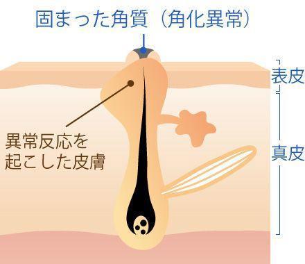 毛孔性苔癬(毛孔性角化症)とは?