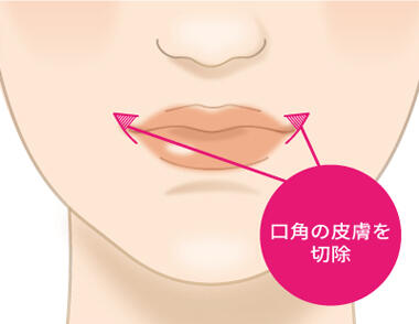 STEP1：口角の皮膚を切除