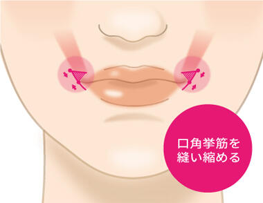 STEP2：口角挙筋を短縮