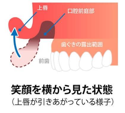 ガミースマイルの原因は？