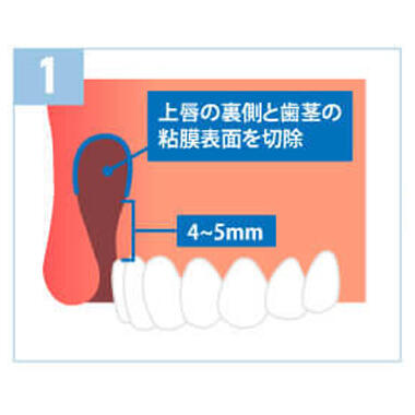 口腔内粘膜切除術（歯茎整形）の特徴1：根本解決を目指せます