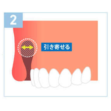 口腔内粘膜切除術（歯茎整形）の特徴2：外から傷跡が見えません