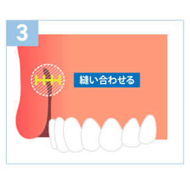 口腔内粘膜切除術（歯茎整形）の特徴3：抜糸や入院は不要です