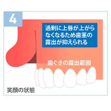 口腔内粘膜切除術（歯茎整形）の特徴4：ボトックスを無料で受けられます