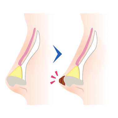 「耳介軟骨移植」でアップノーズを緩和