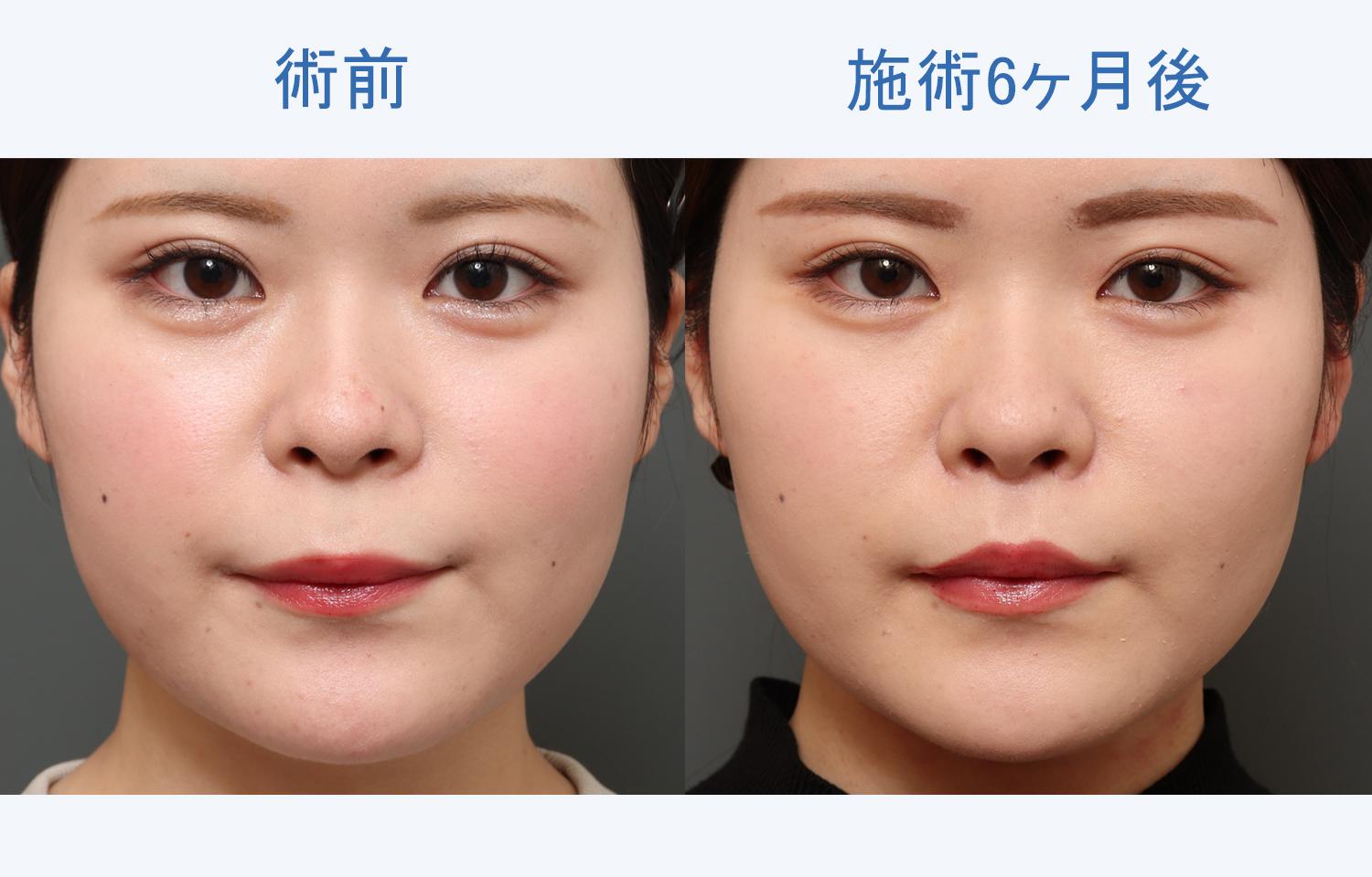 【20代女性ご相談】ぷっくりとした唇になりたい｜人中短縮と口角挙上施術6ヶ月後