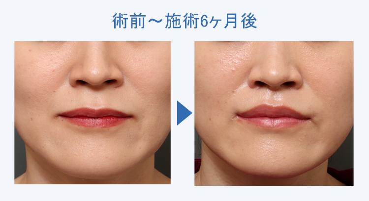 人中短縮+口角挙上 術前術後の比較1