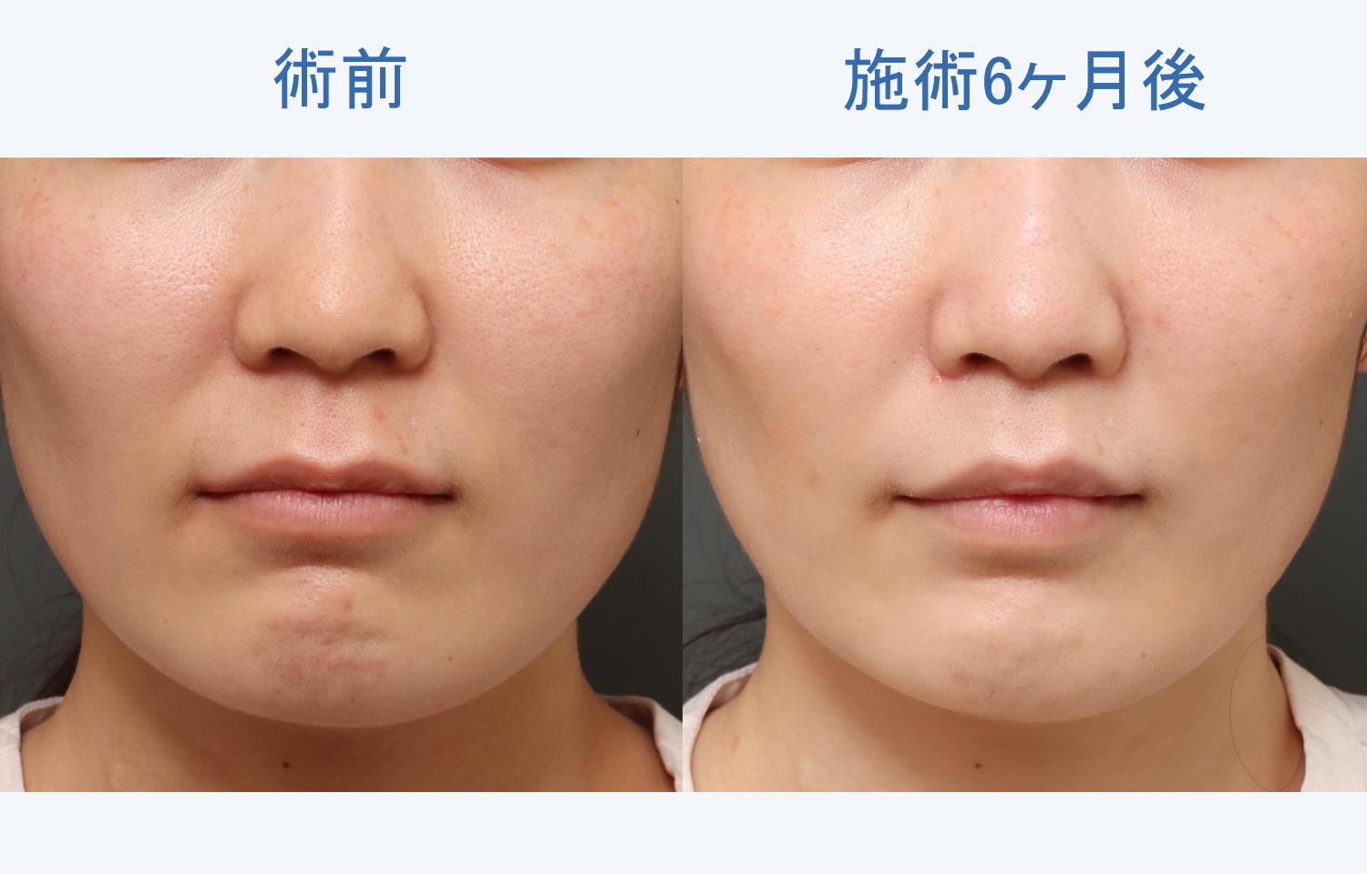 【30代女性ご相談】上唇を厚く上向きにしたい|人中短縮施術6ヶ月後