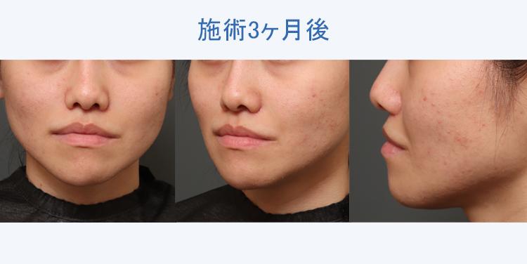 人中短縮+鼻翼縮小+鼻プロテーゼ 施術3ヶ月後の症例写真