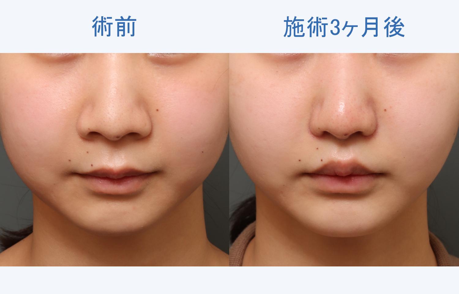 人中短縮+鼻翼縮小+顔の脂肪吸引+バッカルファット除去の3ヶ月後の経過をご紹介！