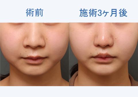 人中短縮+鼻翼縮小+顔の脂肪吸引+バッカルファット除去の3ヶ月後の経過をご紹介！