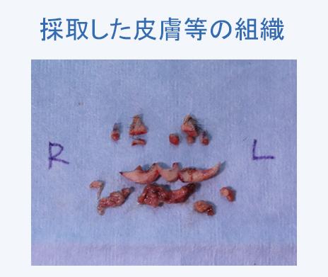 実際に切除した人中、鼻翼の皮膚等の組織